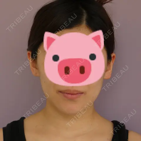バッカルファット除去 / 脂肪吸引（顔） 藤・ナチュレ美容クリニック 恵比寿院 AFTER