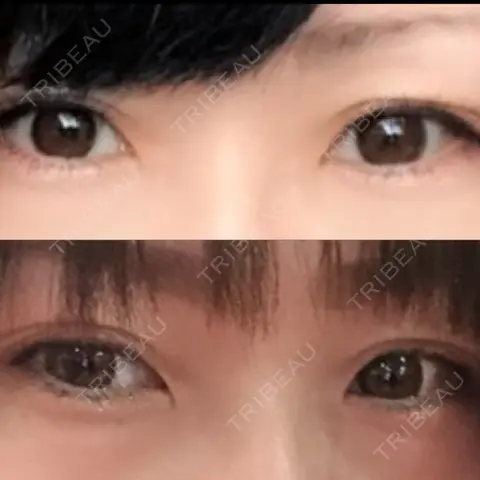 二重埋没 ロレシー美容クリニック 心斎橋駅前院 AFTER