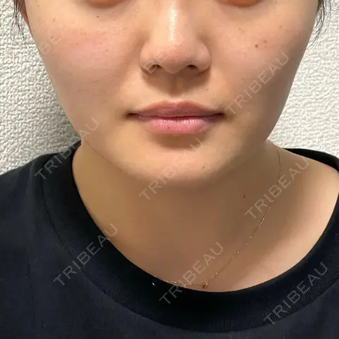 糸リフト 仙台TAクリニック AFTER