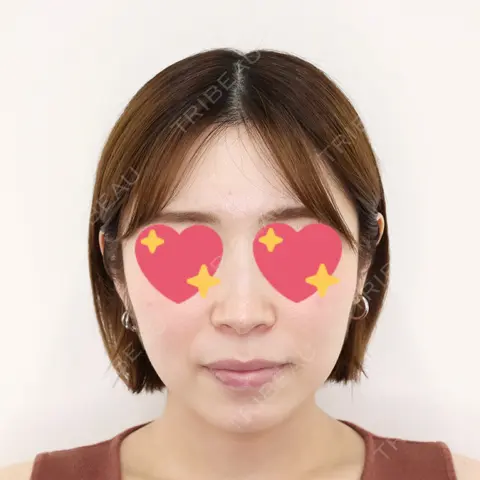 糸リフト / ヒアルロン酸注入（あご） / ボトックス（エラ・小顔） 新宿TAクリニック AFTER