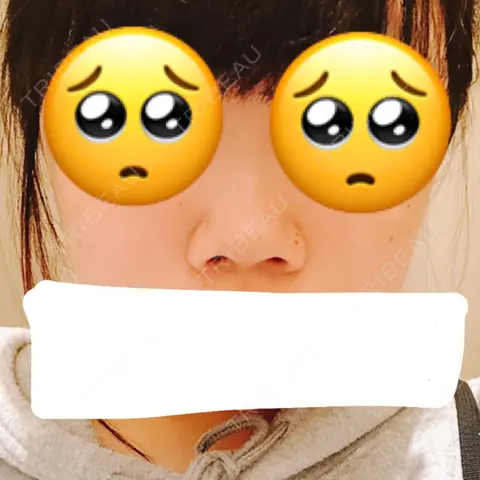 鼻尖形成（切開） / 小鼻縮小（切開） / 軟骨移植 / 眉間プロテーゼ 湘南美容クリニック 熊本院 AFTER