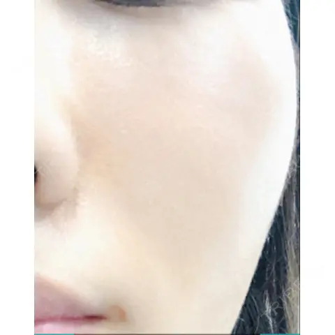 水光注射（ハリ・美肌） リエンジャン整形外科 江南店 AFTER