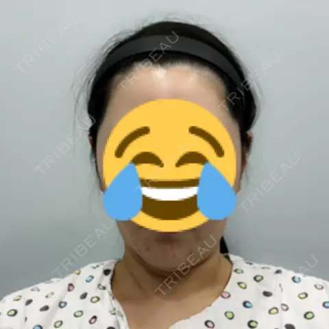 あご下筋肉縛り / その他（輪郭） 21美容外科医院 AFTER