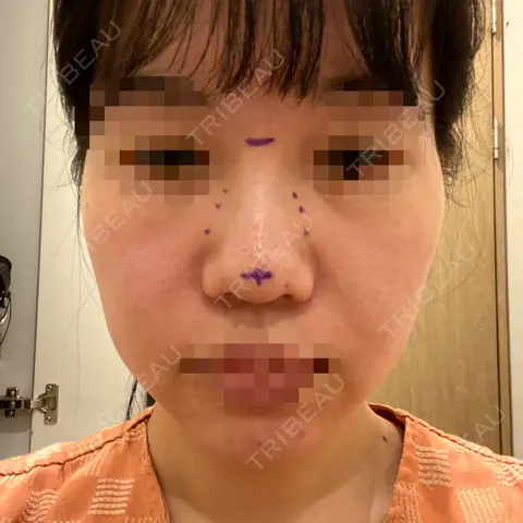 隆鼻術 / 鼻尖形成（切開） / 軟骨移植 / 骨切幅寄せ / 眉間プロテーゼ LUHO（ルホ）美容外科 AFTER