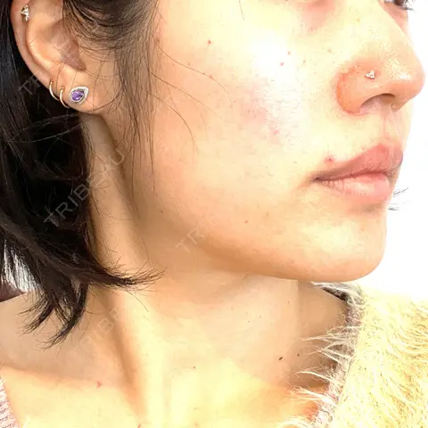 ボトックス（エラ・小顔） / ボトックス（肩） / シワ取りボトックス / ボトックス（首） THE FIRST CLINIC 多摩センター院 AFTER