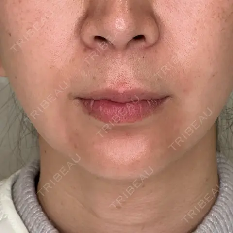 ヒアルロン酸注入（唇） / ボトックス（口角） / ボトックス（人中） KAGA CLINIC AFTER