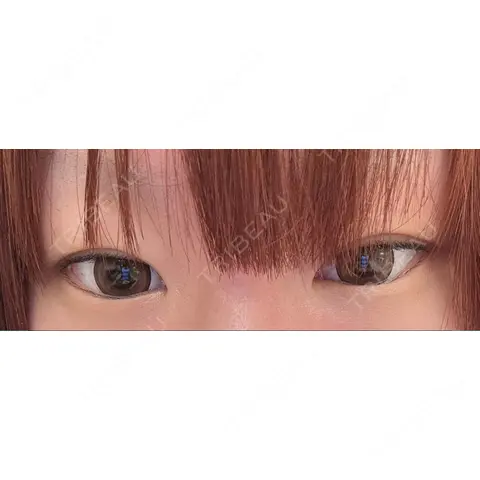 二重切開 / 目頭切開 / 眼瞼下垂（切開） オーキッド美容クリニック東京御徒町 AFTER