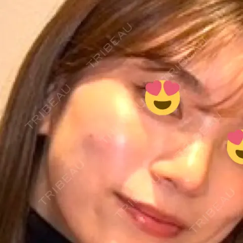 ヒアルロン酸注入（鼻翼基部） 銀座美容外科クリニック 新宿院 AFTER