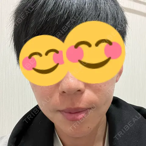 ボトックス（あご） / ヒアルロン酸注入（あご） / ヒアルロン酸注入（鼻翼基部） シェリークリニック 新宿本院 AFTER