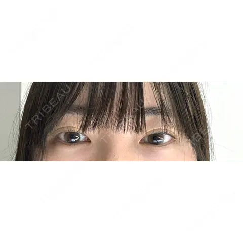 ヒアルロン酸注入（涙袋） 東京皮膚科・形成外科 (銀座いけだクリニック) AFTER