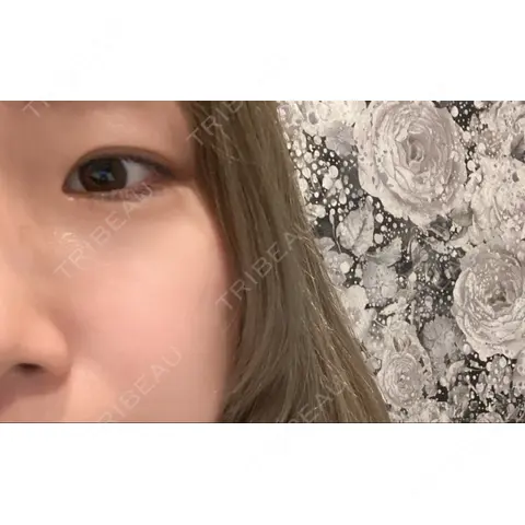 ダーマペン ブリリアスキンクリニック AFTER