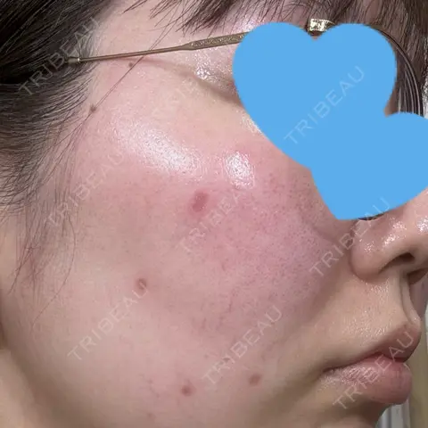 光治療（フォトフェイシャルなど） まゆりなclinic 名古屋栄 AFTER
