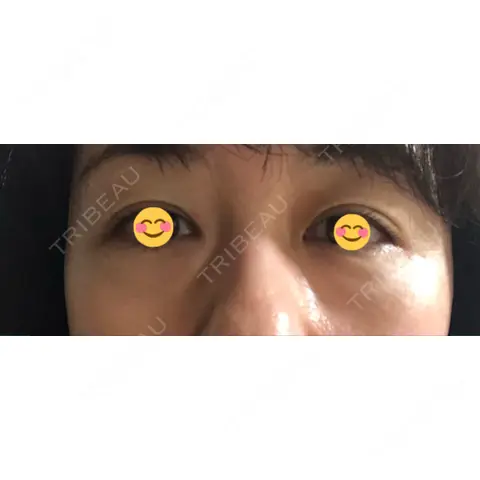 下まぶたたるみ取り / 脂肪注入（肌） X CLINIC 銀座院 AFTER