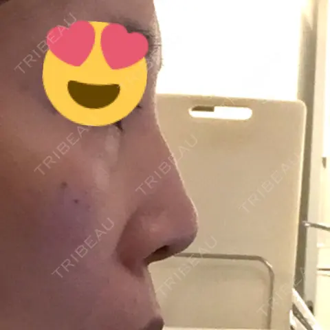 隆鼻術 / 鼻尖形成（切開） / 鼻中隔延長（切開） / 骨切幅寄せ / ワシ鼻修正・ハンプ切除 / ヒアルロン酸溶解 ミナ美容外科 AFTER