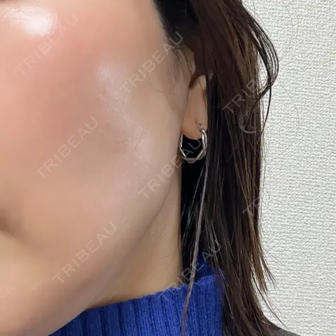 ボトックス（エラ・小顔） 新未来クリニック AFTER