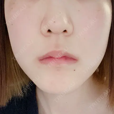 ほくろ・いぼ切除（肌） 巣鴨ほくろ・できものクリニック AFTER