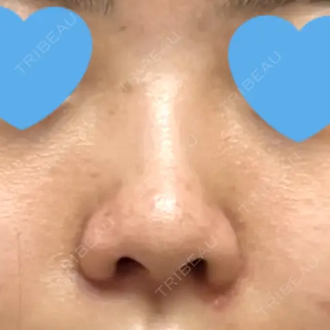 鼻尖形成（切開） / 小鼻縮小（切開） / 軟骨移植 / 鼻柱下降・鼻唇角形成（猫手術） グローバルビューティークリニック 銀座院 AFTER