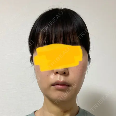 インディバ（顔） WOM SALON【術後ケア取扱いサロン】 AFTER