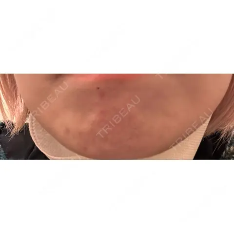 ボトックス（あご） KAGA CLINIC AFTER