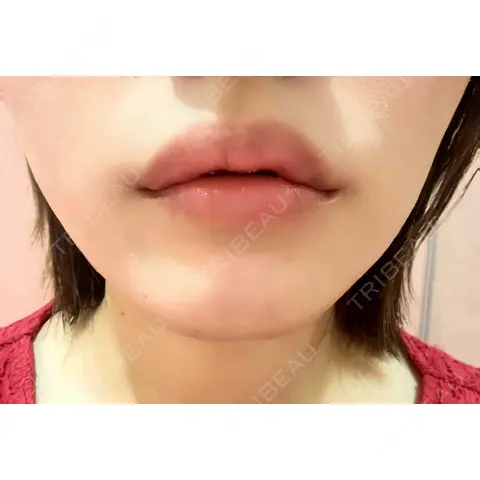 ヒアルロン酸注入（唇） / ボトックス（口角） 共立美容外科 熊本院 AFTER