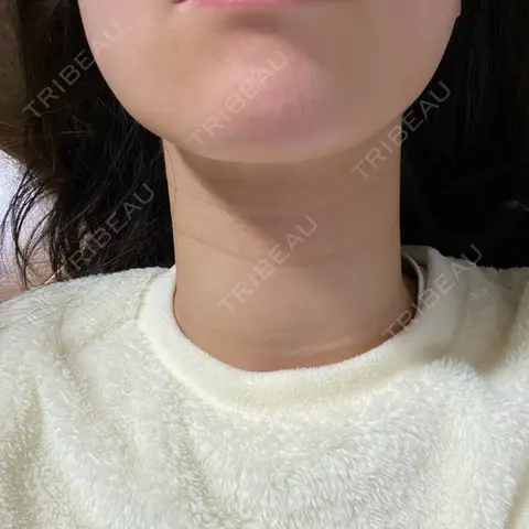 エレクトロポレーション / ルメッカ TIAM CLINIC GINZA AFTER