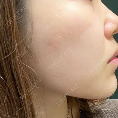 ピーリング（ハリ・ツヤ） 心斎橋KT美容クリニック AFTER