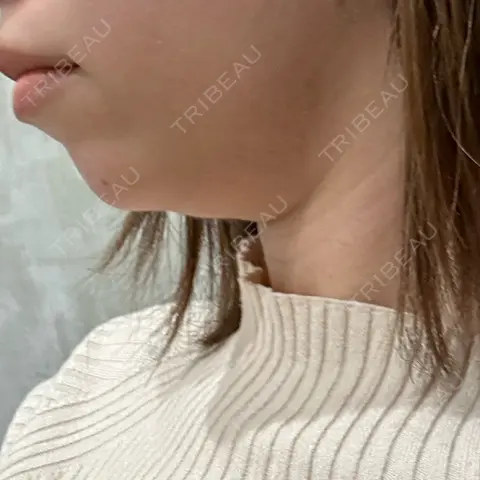 糸リフト / 脂肪吸引注射（顔） EMMO FACE CLINIC 大宮院 AFTER