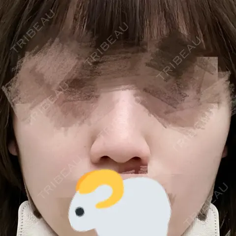 鼻尖形成（切開） / 小鼻縮小（切開） / 鼻孔縁下降 グローバルビューティークリニック 銀座院 AFTER