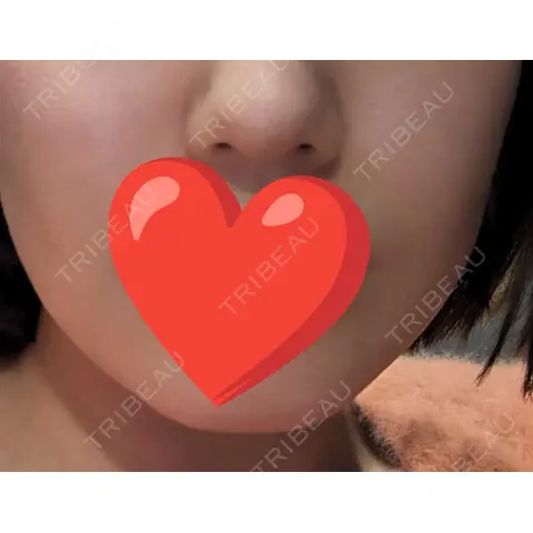 ヒアルロン酸注入（あご） / ボトックス（エラ・小顔） / ボトックス（肩） / ボトックス（首） / ヒアルロン酸注入（鼻翼基部） L‘amour clinic Tokyo【ラムールクリニック東京】 AFTER