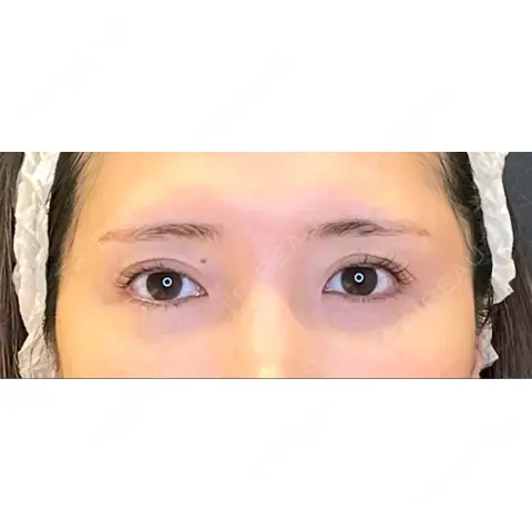 目尻切開 / タレ目形成・グラマラスライン（埋没） LOUIS CLINIC 二子玉川院【ルイクリニック】 AFTER