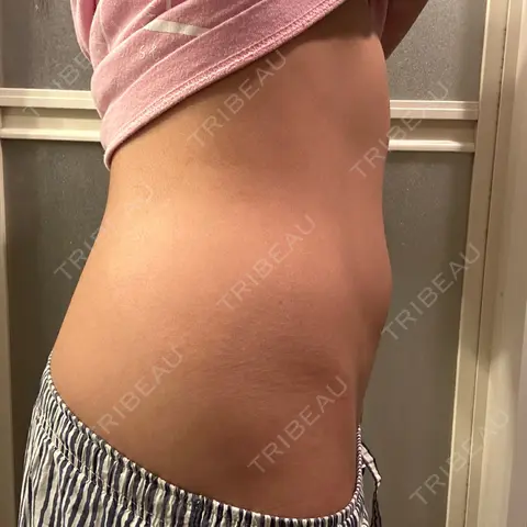 医療痩身（お腹） 湘南美容クリニック 博多院 AFTER