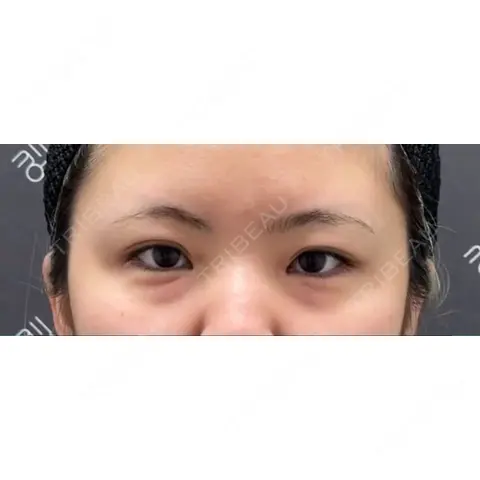 クマ治療 EMMO FACE CLINIC 大宮院 AFTER