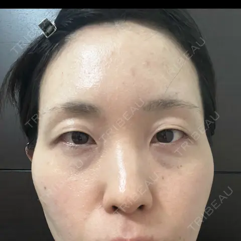クマ治療 / こめかみ形成 / 脂肪注入（額） / 脂肪注入（目の下） / ボトックス（額） X CLINIC 銀座院 AFTER