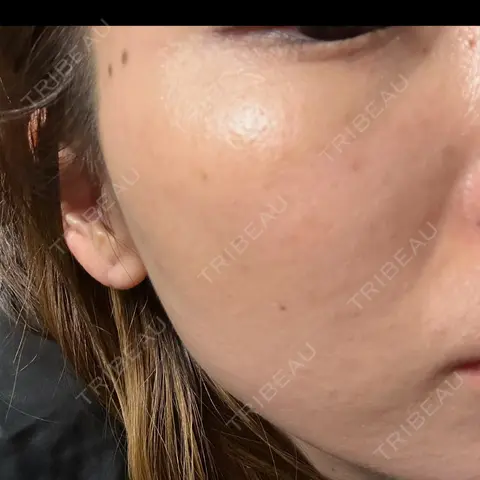 ヴェルヴェットスキン ブリリアスキンクリニック AFTER
