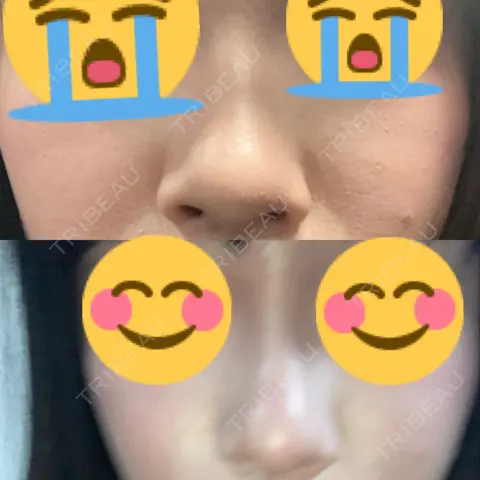 ヒアルロン酸注入（鼻） 東京形成美容外科 船橋院 AFTER