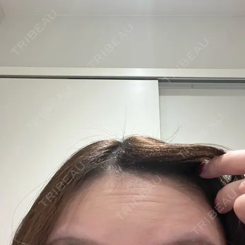 ボトックス（エラ・小顔） ルラ美容クリニック 福岡院 AFTER