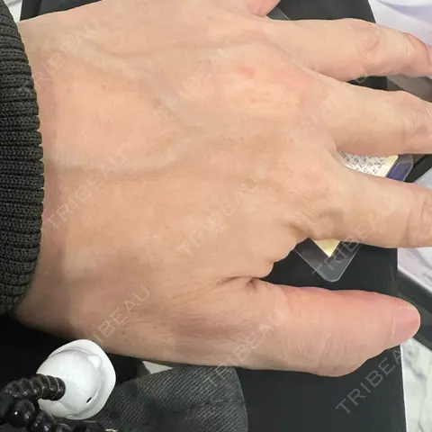 医療脱毛（指） 共立美容外科 名古屋院 AFTER