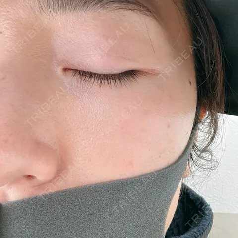 エレクトロポレーション 若倉診療所 AFTER