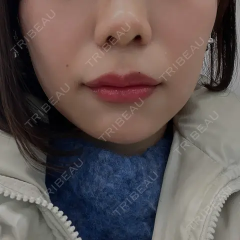 ヒアルロン酸注入（鼻） / ヒアルロン酸注入（唇） / ボトックス（口角） THE FIRST CLINIC 多摩センター院 AFTER