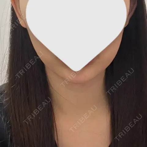 糸リフト / 脂肪吸引（顔） 東京美専クリニック AFTER