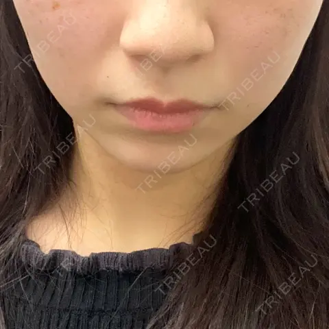 脂肪溶解注射（顔） あいち栄クリニック AFTER