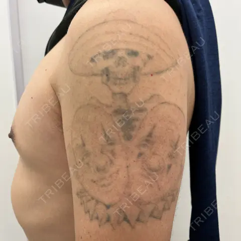 タトゥー除去 東郷美容形成外科 福岡 AFTER