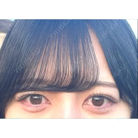二重埋没 / 上まぶたの脂肪取り 9BeautyClinic AFTER