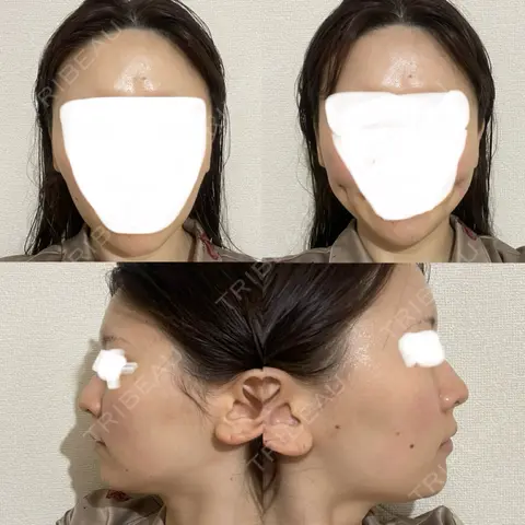 ほくろ・いぼ切除（肌） / 脂肪吸引（顔） / 額を丸く / 脂肪注入（肌） / 脂肪注入（額） 東京美専クリニック AFTER