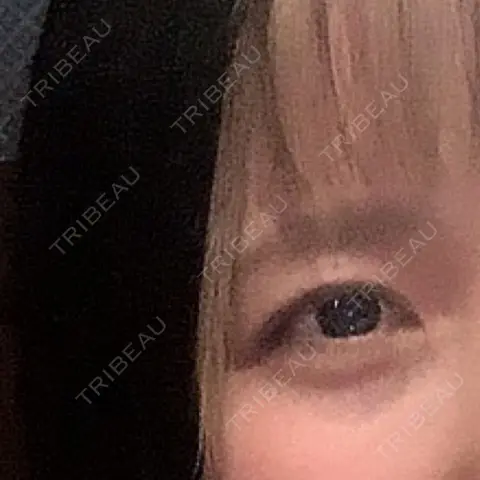 脂肪注入（目の下） 仙台TAクリニック AFTER