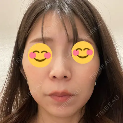 ボトックス（エラ・小顔） KARIS beauty clinic AFTER