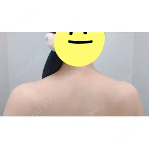 ボトックス（肩） 共立美容外科 京都院 AFTER