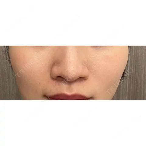 脂肪溶解注射（顔） ロレシー美容クリニック 心斎橋駅前院 AFTER
