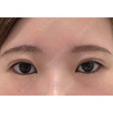 目頭切開 AI Beauty Clinic （エーアイ美容クリニック） BEFORE