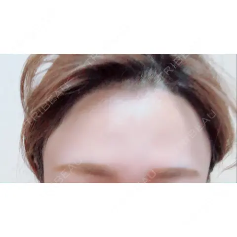 脂肪注入（肌） / 再生医療 / PRP皮膚再生療法 iSTAR美容外科・皮膚科 AFTER